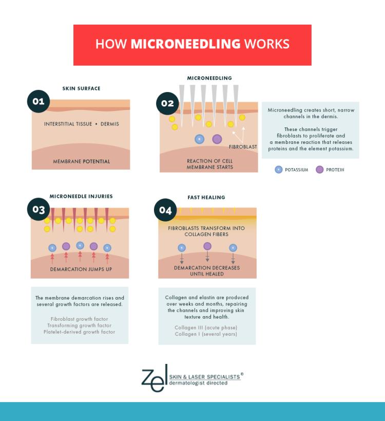 Discover how microneedling works at the Minneapolis area's Zel Skin works, from consultation to treatment to ultimate results.