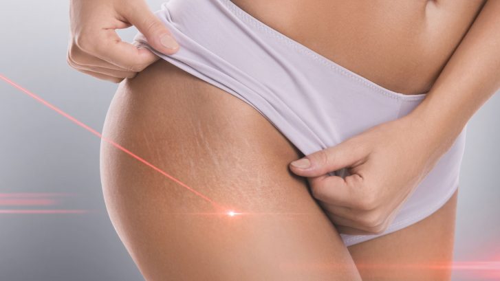 stretch mark removal laser treatment