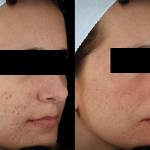 Acne Scaring Treatments Edina *Results may vary per patient.