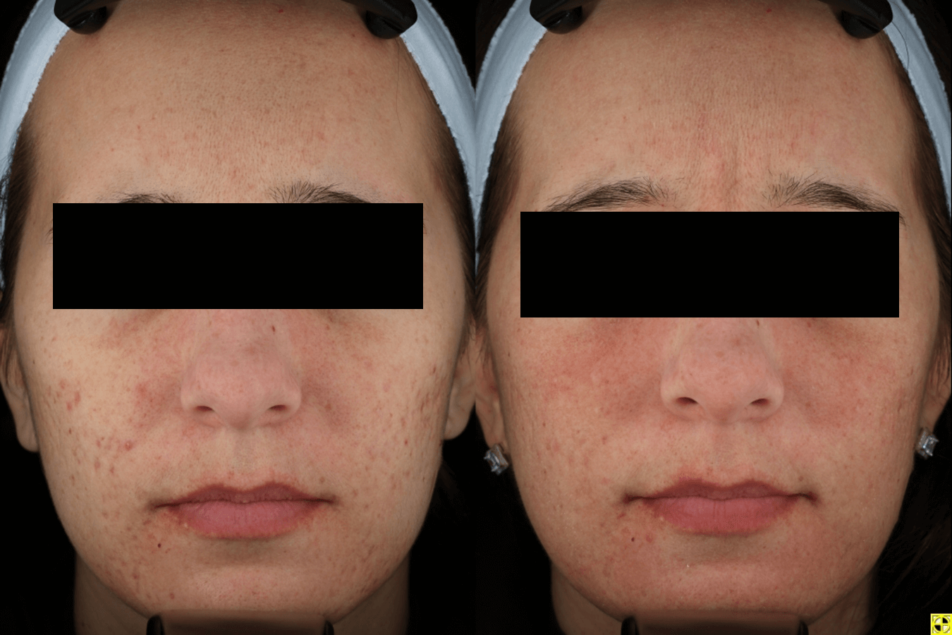 Acne Scaring Treatments Minneapolis *Results may vary per patient.
