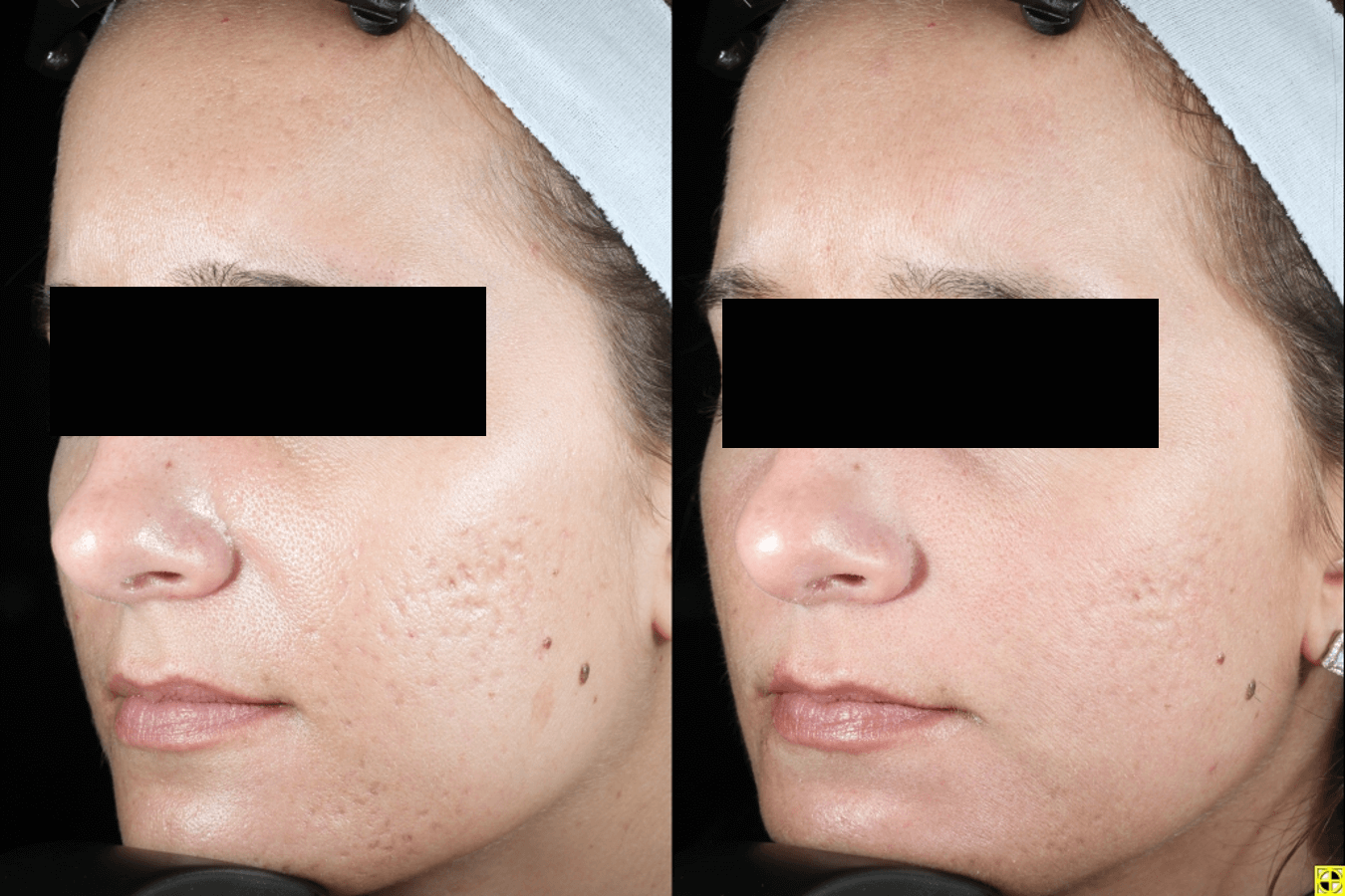 Acne Scaring Treatments Minneapolis *Results may vary per patient.