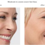 Botox Treatments Minneapolis *Results may vary per patient.