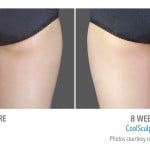 CoolSculpting Minneapolis *Results may vary per patient.