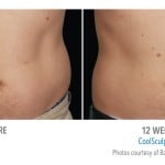 CoolSculpting Minneapolis *Results may vary per patient.