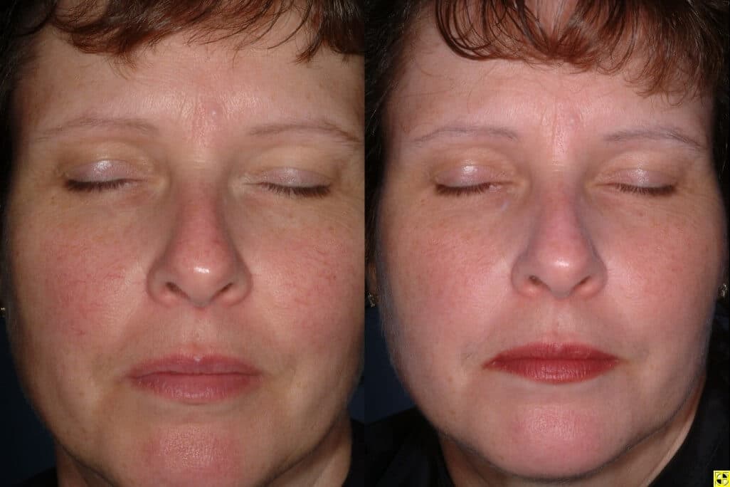 Facial Redness Treatment minneapolis