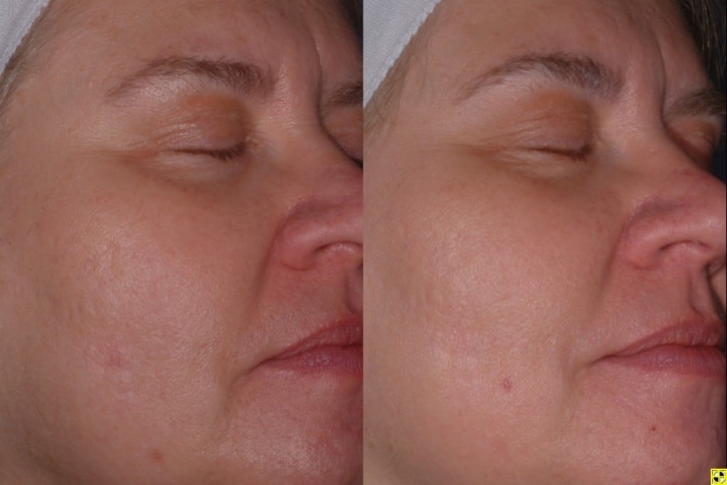 Laser Skin Treatments