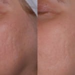 laser skin treatments minneapolis