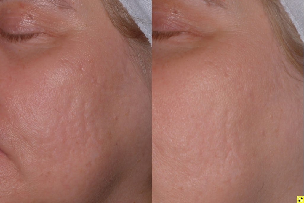laser skin treatments minneapolis