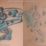 tattoo removal minneapolis