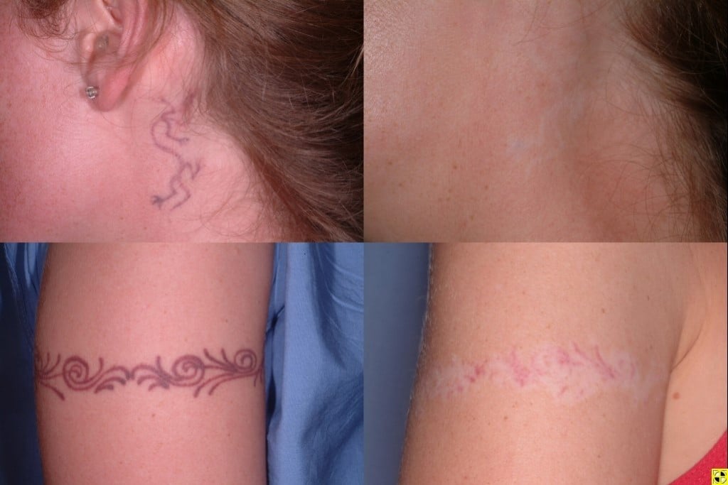 Tattoo Removal- Tattoo clinic listing by state and country