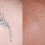 tattoo removal minneapolis