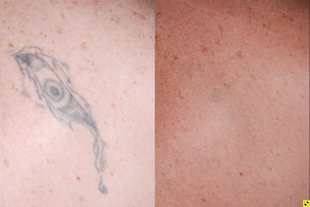 THE BEST 10 Tattoo Removal in Minneapolis MN  Last Updated June 2023   Yelp