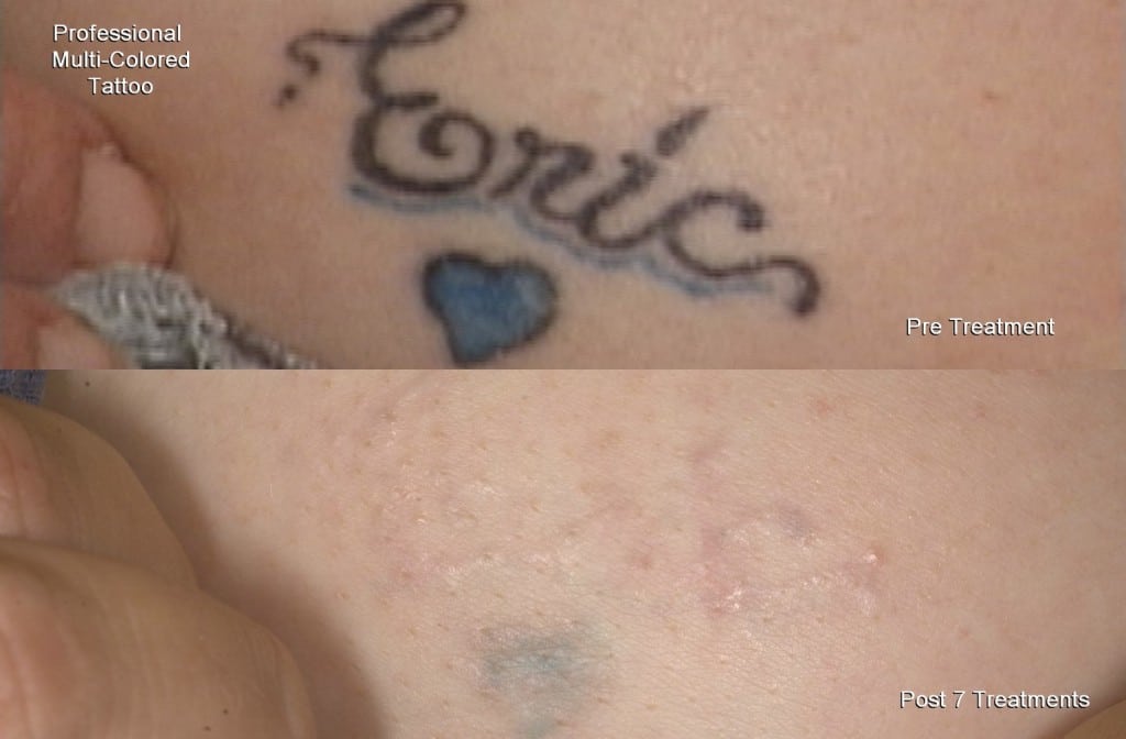 Laser tattoo removal st cloud mn