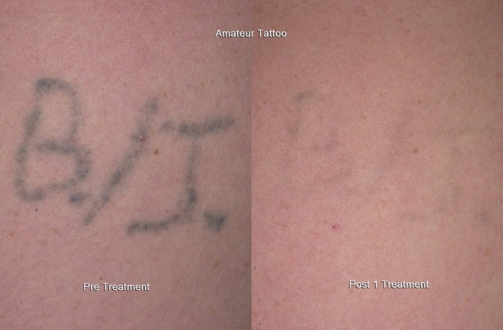 Laser Tattoo Removal - Burt & Will Plastic Surgery and Dermatology