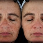 age spot treatments minneapolis