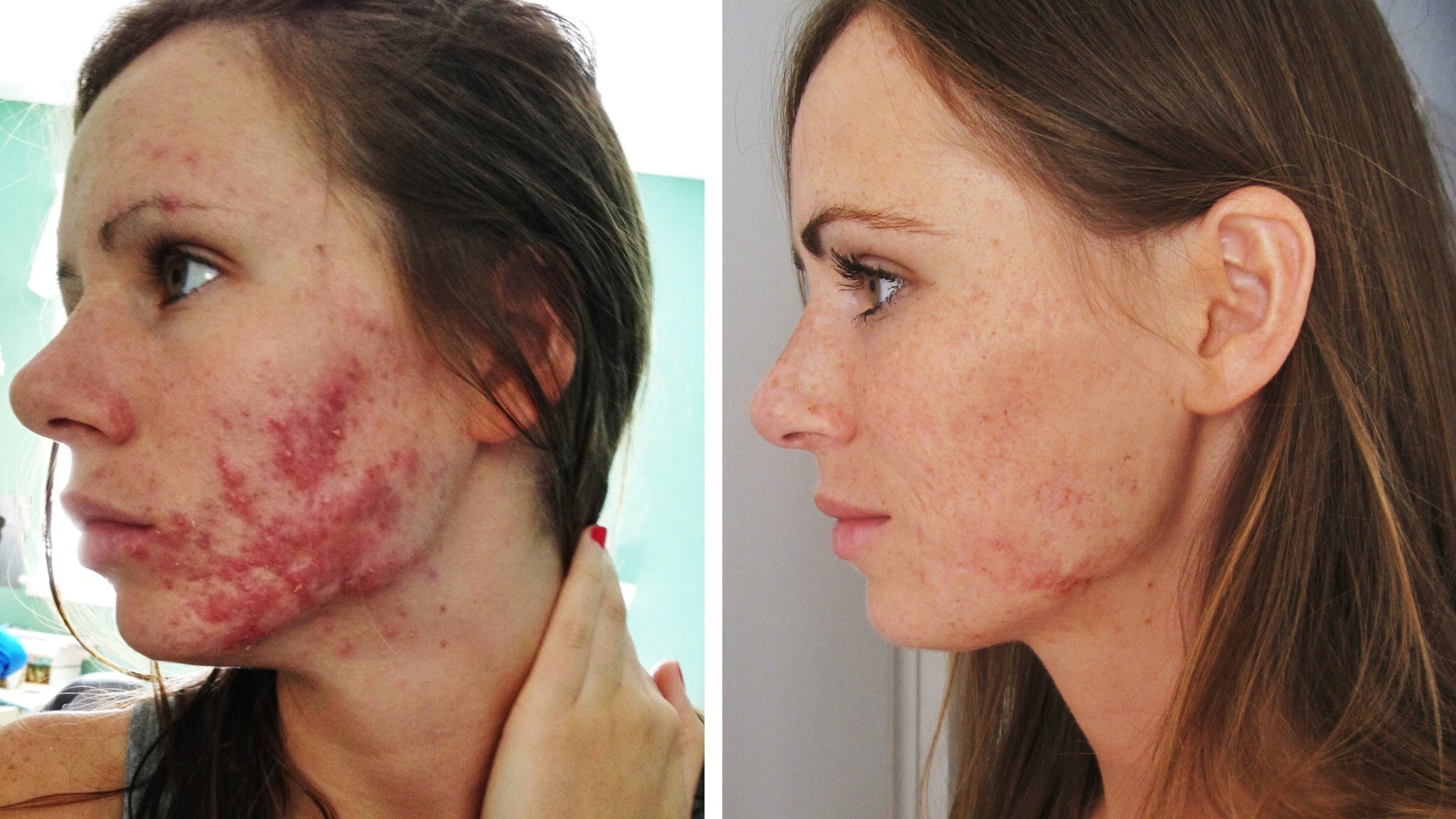 Severe Cystic Acne Accutane