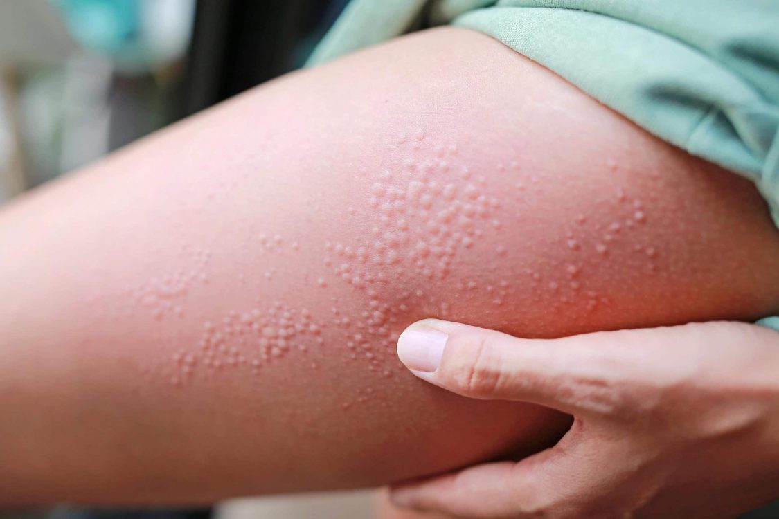 woman with eczema reaction on leg - eczema awareness month