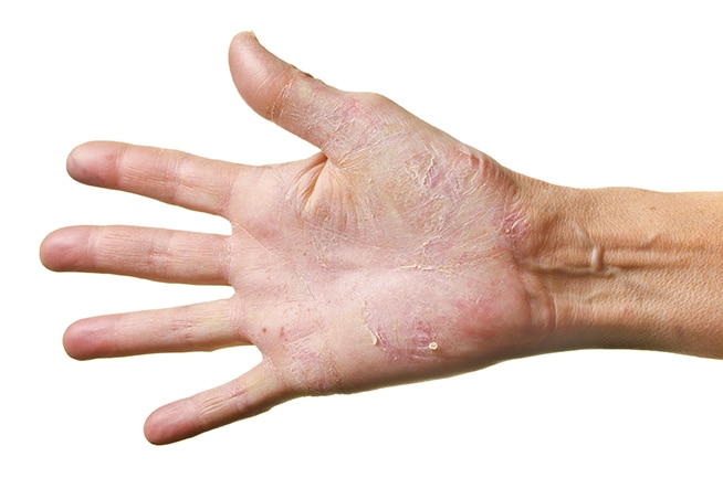 hand dermatitis