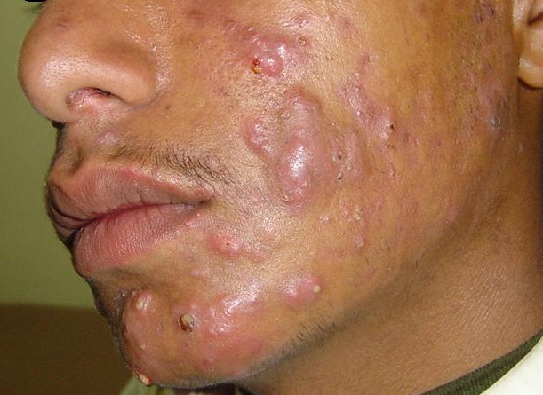 acne cyst
