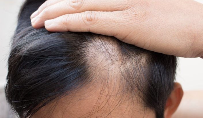 When to See a Dermatologist for Hair Loss - Zel Skin & Laser Specialists