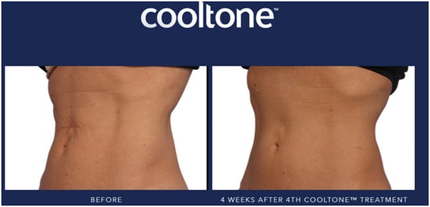 Cooltone treatment results