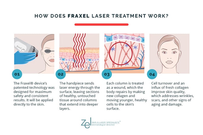 Fraxel treatments at Minneapolis, Edina, and Plymouth's Zel Skin involve the use of a handheld laser device to improve skin quality by triggering collagen production.